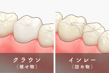 クラウン（被せ物）、インレー（詰め物）