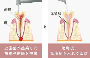 虫歯菌が感染した歯質や歯髄を除去/消毒後、充填剤を入れて密封