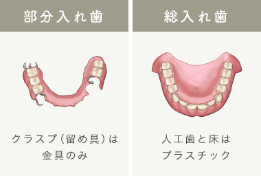 部分入れ歯：クラスプ（留め具）は金具のみ/総入れ歯：人工歯と床はプラスチック