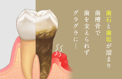 歯石と歯垢が溜まり歯槽骨で歯を支えられずグラグラに…