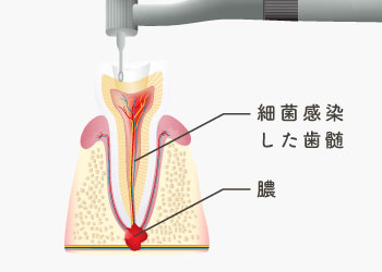 細菌感染した歯髄、膿