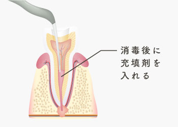 消毒後に充填剤を入れる