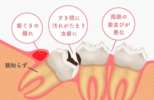 歯ぐきの腫れ/すき間に汚れがたまり虫歯に/周囲の歯並びが悪化
